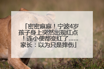 密密麻麻！宁波4岁孩子身上突然出现红点！连小便都变红了……家长：以为只是摔伤
